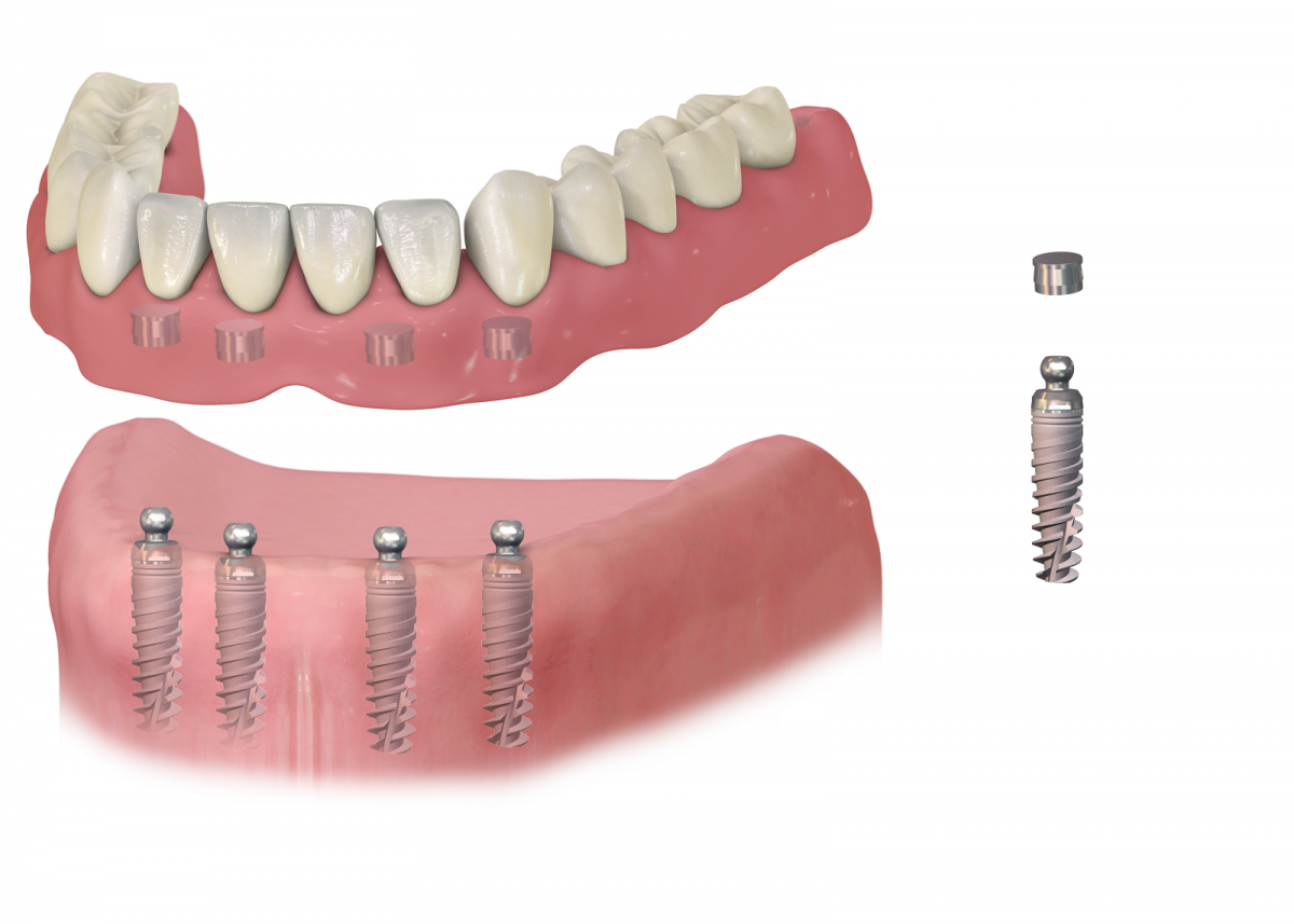 Ohne zahnersatz gaumenplatte oberkiefer Zahnprothese ohne